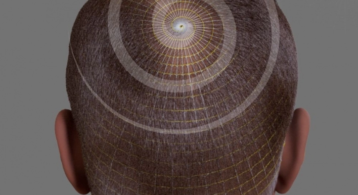 Doğallığı Hedef Alan Son Teknik “Arşimed Saç Ekimi”