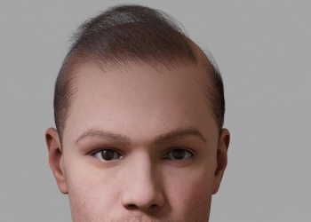 Saç Ekimi Neden “Doğal” Gözükmez?